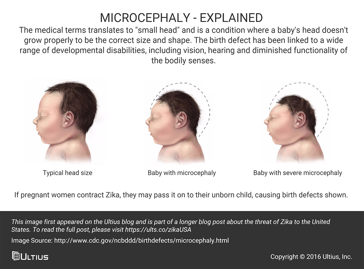 Microcephaly birth defect from Zika